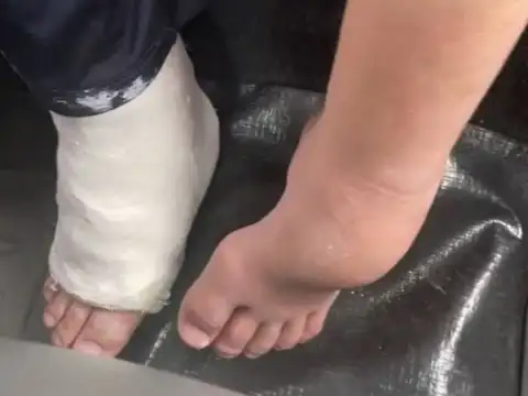 Erro médico em Vilhena: Menino autista tem pé engessado por engano, veja vídeo